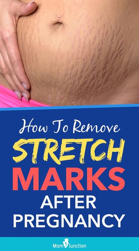 Stretch Mark Remedies, Best Anti Aging Skin Care, Lotion For Oily Skin, Tips For Oily Skin, Stretch Mark Removal, Close Family, Baking Soda Shampoo, Healthy Advice, Moisturizer For Oily Skin