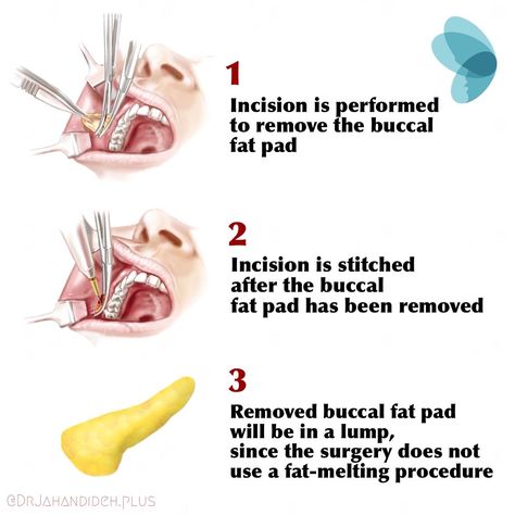 Buccal Fat Removal, Jordan Barrett, When To Plant Vegetables, Fat Removal, Cosmetic Procedures, Vision Boards, Favorite Pins, Plastic Surgery, Glow Up?