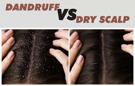 Decode the difference between dry scalp vs. dandruff and discover effective solutions for a healthier, flake-free scalp. - #Dehydratedscalpvs.dandruff #Differentiatingscalpproblems #Differentiationofscalpissues #Discerningdryscalpfromdandruff #Dryscalpdifferentiationfromdandruff #Dryscalpordandruff #Drynessanddandruffcomparison #Drynessversusdandruff #Drynessvs.dandruff... Dry Scalp Vs Dandruff, Dry Flaky Scalp, Laser Hair Removal Cost, Dandruff Causes, Home Remedies For Dandruff, Oils For Dandruff, Kids Skin Care, Dandruff Remedy, Getting Rid Of Dandruff