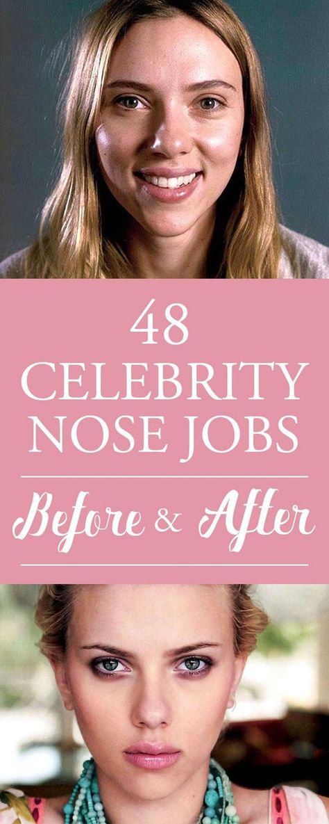 Best Rhinoplasty Before After, Celebs With Big Noses, Celebrities With Big Noses, Wide Nose Women, Women With Big Noses, Nose Job Before And After, Blake Lively Nose, Big Nose Women, Celebrity Nose Jobs