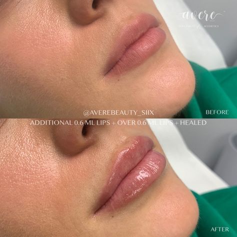 Super Natural Lip Filler, Upper Lip Filler Before And After, 1 Ml Lip Filler Before And After, 0.5ml Lip Filler Before And After, Subtle Lip Filler Before And After, Subtle Lip Filler, 0.5 Ml Lip Filler Before And After, Lip Filler Before And After, Lips Injection