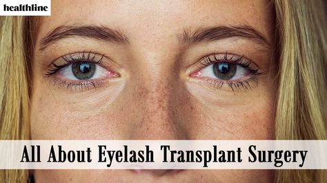 What is eyelash transplant surgery? “Eyelash transplant surgery involves moving hair from one part of the body (usually the back of the head) to the eyelash area (upper or lower eyelid),” explained board-certified plastic surgeon Gary Linkov, MD. “This helps guarantee a fuller and longer lash appearance,” he said. Read More Eyelash Implants, Facial Plastic, Back Of The Head, Long Lashes, Plastic Surgeon, The Head, Your Head, Surgery, Eyelashes