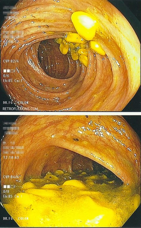 A gastroenterologist cheats on the colonoscopy prep and wins! | retroflexions.com Colonoscopies Prep Diet, Colonoscopies Prep Meals, Clear Liquid Diet Ideas, Endoscopy Humor, Colonoscopies Prep Food, Colonoscopies Humor, Endoscopy Technician, Clear Liquid Diet Recipes, Colon Hydrotherapy Benefits