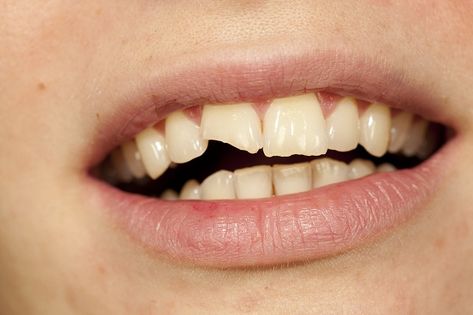 #Chippedteeth can be bothersome, both physically and aesthetically. Depending on the size and location of the chip, there are numerous repair solutions available. Tooth Extraction Aftercare, Tooth Extraction Healing, Cracked Tooth, Chipped Tooth, Tooth Repair, Kedokteran Gigi, Dental Implant Surgery, Dental Implants Cost, Emergency Dentist