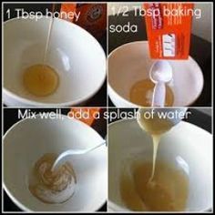 You can mix baking soda with honey and make an excellent product to exfoliate your skin. You can leave this same product on for about 20 minutes to lessen or lighten acne scars. Be sure to wash your face well when you are done. Acne Overnight, Pimples Overnight, Pimples Remedies, Diy Acne, Get Rid Of Acne, Rid Of Acne, Natural Acne, How To Get Rid Of Pimples, Hair Remedies