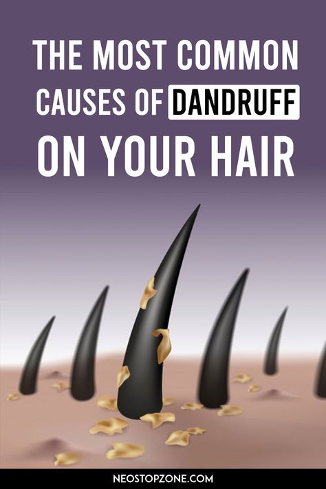 When you have a dry scalp situation, it's possible you'll already be experiencing flakiness and itchiness in certain areas more than others. But when the mane is overwashed or not oiled, a dry scalp will lack moisture and this might result in dandruff. Extreme shampooing can strip the scalp of its natural oils, therefore, resulting in more dryness, itchiness, and flakes. Curly Hair Dandruff, Tips For Dandruff And Dry Scalp, White Flakes In Hair Dry Scalp, Diy Hair Mask For Dandruff, How To Stop Dandruff And Hairfall, Dry Scalp Vs Dandruff, Products For Dandruff Dry Scalp, What Is Dandruff, Hair Flakes