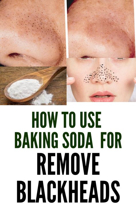 It helps in the exfoliation of the dead skin cells making the pores and skin clear. Know about how to use baking soda to reduce blackheads. #beauty #blackheads #DIY Baking Soda Face Mask, Remove Blackheads From Nose, How To Remove Blackheads, Blackhead Remover Diy, Remove Skin Tags Naturally, Clear Blackheads, Diy Makeup Remover, Face Mask For Blackheads, To Remove Blackheads