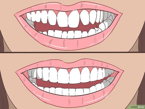 How to Straighten Your Teeth Without Braces (with Pictures) Straighten Teeth Without Braces, Dental Photos, Teeth Whitening Procedure, Get Whiter Teeth, Natural Face Cleanser, Teeth Bleaching, Teeth Straightening, Perfect Teeth, Teeth Shape