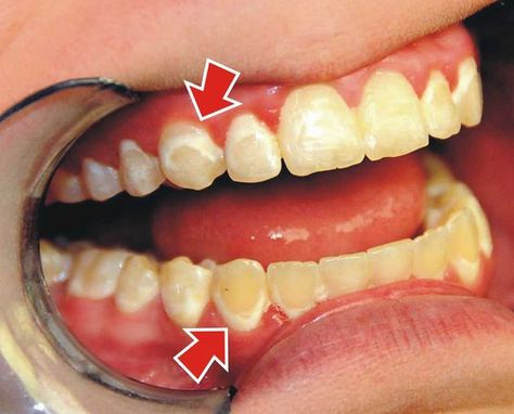 White Spots After Braces if teeth are not brushed properly and plaque is left around the bracket Teeth After Braces, After Braces, Plaque Teeth, Braces Tips, Braces Off, Discolored Teeth, Teeth Whitening Toothpaste, Charcoal Teeth Whitening, Dental Braces