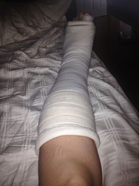 Leg Fracture Snapchat, Broke Leg Snapchat, Fracture Photo, Clear Glasses Frames Women, Whale Tail Thong, Broken Ankle, Hospital Photography, Hospital Pictures, Girls Dorm Room