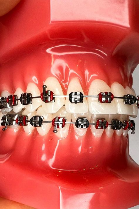 Red And Black Braces, Red Braces Color, Braces Combos, Braces Color Combos, Black Braces Bands, Braces Journey, Braces Colors Combinations, Red Braces, Silver Braces