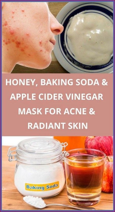 Honey, Baking Soda and Apple Cider Vinegar Mask For Acne and Radiant Skin Honey Baking, Mask For Acne, Baking With Honey, Natural Cough Remedies, Cough Remedies, Healthy Fitness, Cider Vinegar, Apple Cider Vinegar, Health Remedies