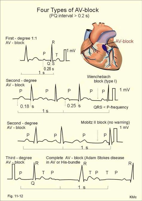 Ekg gold for nursing students Ekg Interpretation, Paramedic School, Nursing Mnemonics, Cardiac Nursing, Nursing School Survival, Critical Care Nursing, Nursing School Studying, Nursing School Tips, Nursing School Notes