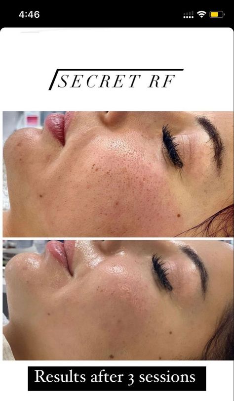 Dermapen Microneedling, Facial Massage Techniques, Bad Eyebrows, Skin Care Pictures, Facial Cupping, Laser Resurfacing, Facial Fillers, Skincare 101, Skin Advice