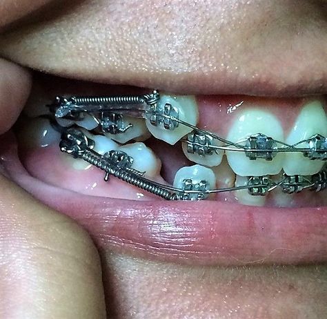 Braces With Springs, Braces Problems, Types Of Braces, Adult Braces, Brace Face, Braces Colors, Orthodontics Braces, Metal Braces, Teeth Braces