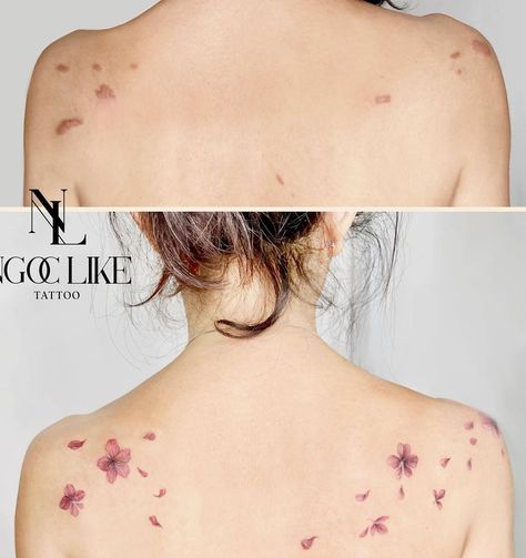 Burn Tattoo Cover Up, Tattoos Around Birthmarks, Acne Scar Tattoo Coverup, Birthmark Cover Up Tattoo, Keloids Tattoo Cover Up, Scar Tattoos Women, Tattoo To Cover Scars, Wound Tattoo, Thigh Tats