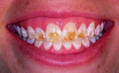 Dental Fluorosis, Dental Animation, Biology Projects, Medical Animation, Perfect Teeth, Brushing, Teeth Whitening, Biology, Medical