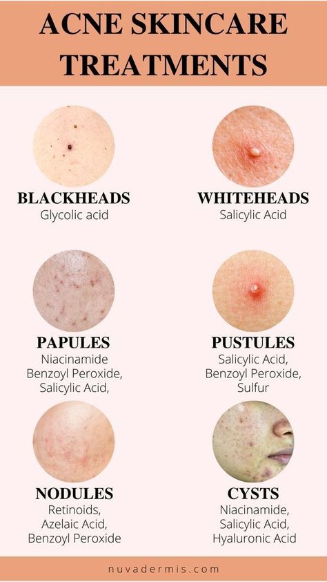 Night Beauty Routine, Beauty Hacks Skincare, Natural Acne Remedies, Natural Acne, Clear Skin Tips, Acne Solutions, Acne Care, Clearer Skin, Acne Free