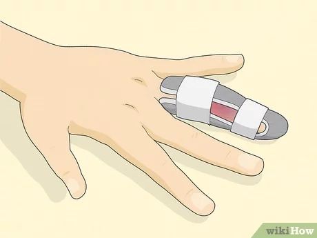 How to Determine if a Finger Is Broken: Symptoms & More Diy Finger Splint, Broken Finger Splint, Medical Stitches, Fractured Finger, Jammed Finger, Flex Seed, Hairline Fracture, Finger Injury, Broken Finger