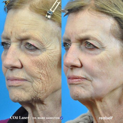 Cosmetic Fillers, Laser Skin Rejuvenation, Laser Skin Tightening, Laser Facial, Laser Skin Resurfacing, Skin Tightening Treatments, Fractional Laser, Laser Resurfacing, Makeup Tips For Older Women