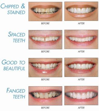 Dental Bridge Cost, Snap On Smile, Cosmetic Dentistry Procedures, Laser Teeth Whitening, Teeth Implants, Dental Bridge, Dental Veneers, Dental Cosmetics, Dental Procedures