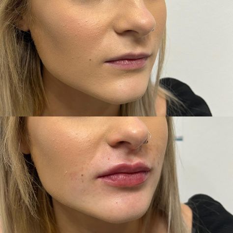 1ml Lip Filler Shapes, Lip Filler Pouty Lips, Lips Before And After Injections, 1 Ml Lip Filler Before And After, Lip Injections Before And After, Lip Flip Botox Before And After, Lip Filler Before And After, 1ml Lip Filler, Eye Lift Surgery