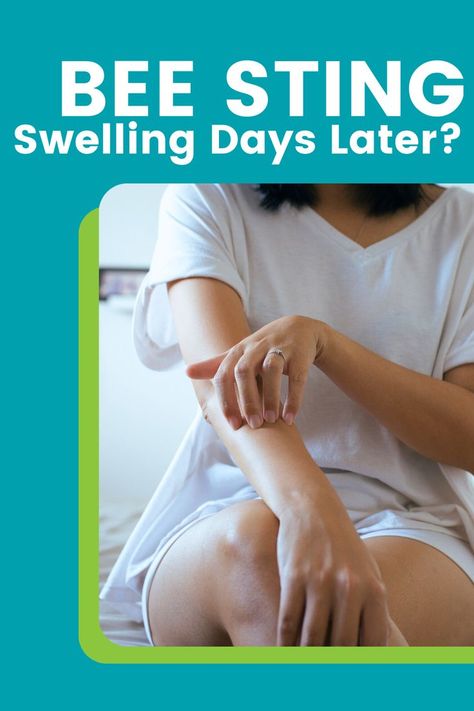 If you experience a bee sting swelling days later, you aren’t alone. Discover why this can happen and what symptoms to watch for. Bee Sting Swelling, Swelling Remedies, Bee Sting, Allergy Symptoms, What To Use, Allergies, Bee