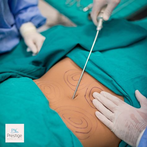 Why choose MicroAire Liposuction? ❌ No general anesthesia ❌ No surgery ☑️ Easy recovery ☑️ Results within 3 weeks Schedule a consultation with our specialist 👉 https://www.pacboca.com/liposuction #liposuction #medspa #confident #beauty #bocaraton #miznerpark #antiaging Prestige Aesthetic, Lipo Hd, Body Surgery, General Anesthesia, General Anaesthesia, Aesthetic Clinic, Med Spa, Plastic Surgery, Homework