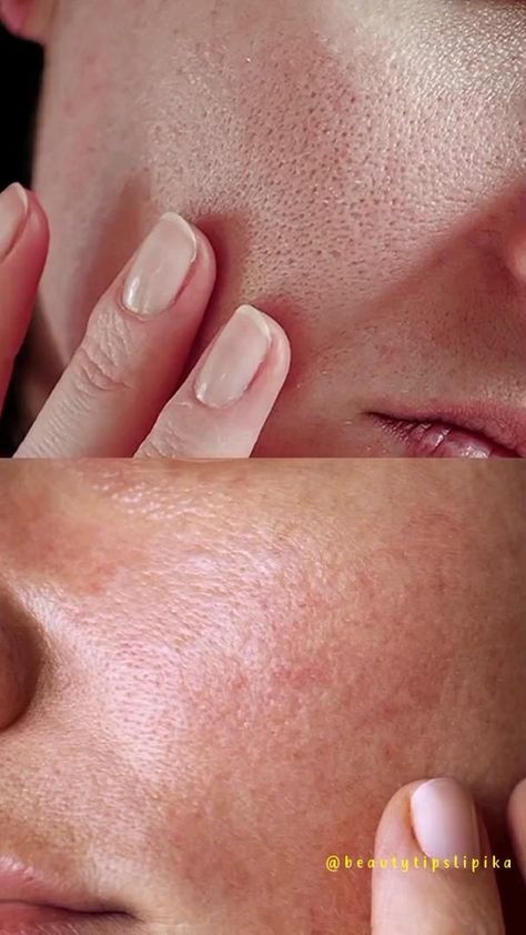 1 Ingredients can treat open pores and Oily Skin on face  #oilyskin #openpores Open Pores On Face, Get Rid Of Pores, Clear Skin Face Mask, Skin Care Home Remedies, Face Routine, Face Skin Care Routine, Dry Skin Care Routine, Clear Skin Face, Oily Skin Care Routine