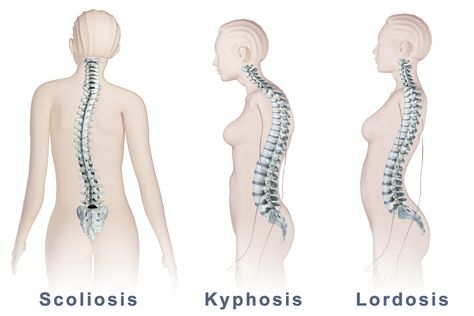 Spinal Deformity Types: Scoliosis, Lordosis, & Kyphosis, Muscular System Anatomy, Lumbar Lordosis, Chronic Lower Back Pain, Hamstring Stretch, Best Ab Workout, Yoga Therapy, Body Is A Temple, Nclex, Low Back Pain