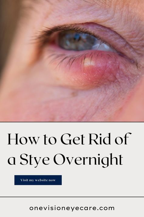 A lot of things can cause a stye, and some are completely in your control. In this article, I am going to cover things you can do to help prevent styes and at the end I’ll give you my tip on how to get rid of a stye overnight. Sty Remedy How To Get Rid, Sty In The Eye Remedies How To Get Rid, Get Rid Of A Stye Overnight, Remedies For Stye On Eyelid, What Causes A Stye In Your Eye, How To Get Rid Of Stye Eye, How To Get Rid Of A Stye On Your Eyelid, Sty Eye Remedies How To Get Rid, Eyelid Irritation Remedies