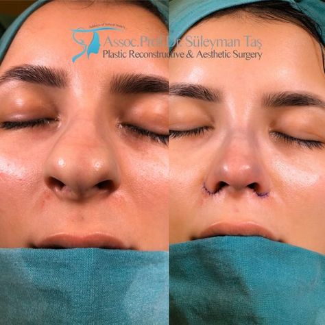 Thick Skin Bulbous Tip Rhinoplasty | Assoc. Prof. Dr. Suleyman TAS Bulbous Tip Rhinoplasty, Tip Rhinoplasty, Jaw Reduction Surgery, Nose Surgery Rhinoplasty, Bulbous Nose, Plastic Surgery Fail, Rhinoplasty Nose Jobs, Plastic Surgery Gone Wrong, Face Surgery