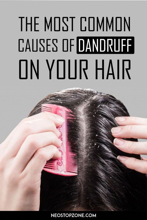 Dandruff is a troublesome hair issue that would occur to anybody, and it's nothing to be embarrassed about. Dandruff is a skin situation that happens on the Oily Dandruff Scalp, Bad Dandruff, What Is Dandruff, Hair Groth, Skin Fungus, Severe Dandruff, Dandruff Causes, Scale Skin, Flaky Scalp