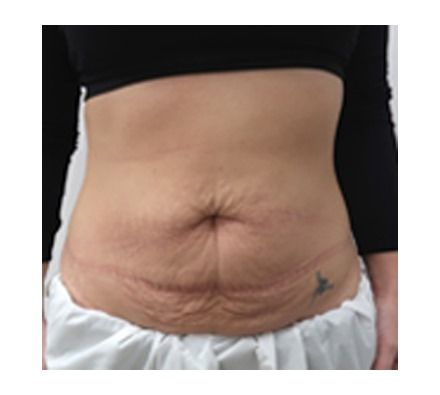 Mummy Tummy Makeover| Dr Leah Clinics Best Stretch Mark Removal, Laser Skin Tightening, Mummy Tummy, Anti Wrinkle Injections, Skin Tightening Treatments, Aesthetic Doctor, Fractional Laser, Tighten Loose Skin, Cosmetic Clinic