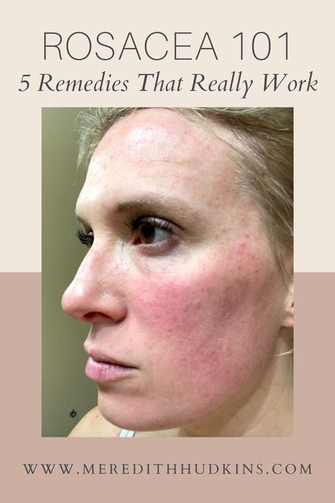 Skin Care Treatments Faces, Redness Reducing Skin Care Natural, Get Rid Of Facial Redness, Skincare For Rocesea, Facial Redness Remedies, Get Rid Of Redness On Face, Rosatia Remedies, Face Redness Remedy, Roscea Help