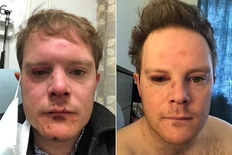 A Broadway actor was sucker-punched by a lunatic in a Manhattan subway station on Tuesday, suffering a fractured eye socket and a torn retina. Alex Weisman, 33 — a member of the original cast of &#… Torn Retina, Nyc Subway Station, Eye Socket, Laser Eye Surgery, Sucker Punch, Subway Station, Originals Cast, Eye Surgery, Nyc Subway