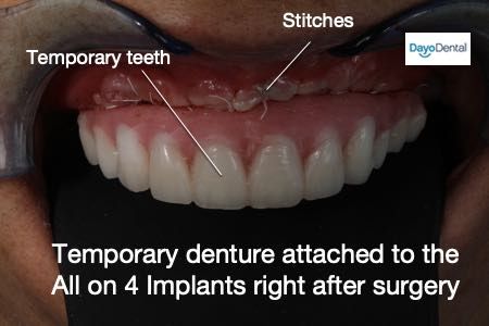 All on 4 Dental Implants - 8 Common Mistakes to Avoid Clear Choice Dental Implants, Full Mouth Dental Implants, All On Four Dental Implants, Dental Implants Before And After, All On 4 Dental Implants, Temporary Tooth, Implant Dentist, Denture Implants, Dental Implant Surgery