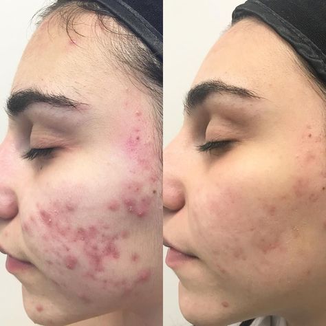 This before and after results are four months apart and was achieved using DMK products by Euphoria Skin Rso Oil, Hydrafacial Before And After, Facial Machines, Facial Before And After, Before And After Acne, Skin Care Pictures, Acne Face, Butterfly Printable, Face Acne