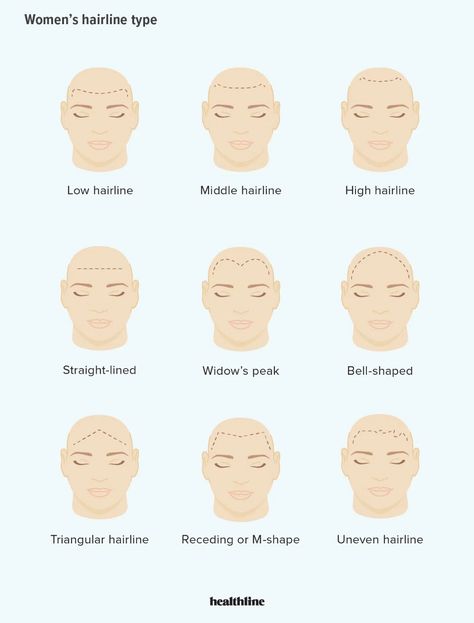 Hairline Types For Men and Women, Plus How to Change Your Type Hairline Types, Male Hairline, Uneven Hairline, Androgenic Alopecia, Traction Alopecia, Stop Hair Breakage, Female Pattern Baldness, Androgenetic Alopecia, Male Pattern Baldness