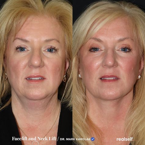 Plastic surgeons share five facelift recovery concerns, some of them common and treatable and others more under-the-radar. Facelift Recovery, Pixie Ears, Facelift Surgery, Facelift Before And After, Facelift Procedure, Face Lift Surgery, Plastic Surgery Procedures, Excess Skin, Under The Knife