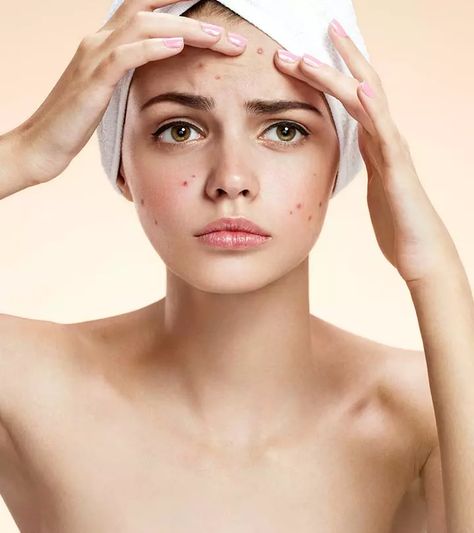 19 Best Home Remedies To Get Rid Of Blemishes On Face Remove Pimples, Natural Acne Remedies, How To Get Rid Of Pimples, Blemish Remover, How To Remove Pimples, Skin Blemishes, Acne Remedies, Unwanted Hair Removal, How To Get Rid Of Acne