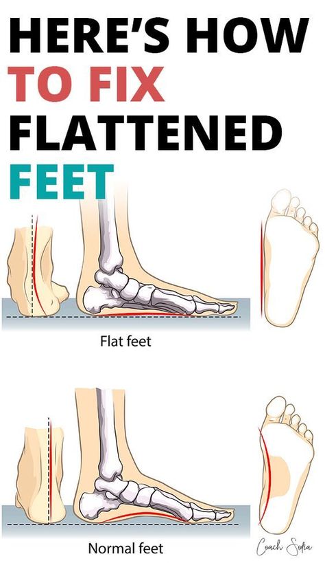 Flat Feet Exercises For Kids, Flat Feet Remedies, Flat Feet Exercises, Exercise Coach, Fallen Arches, Foot Exercises, Flat Foot, Nerve Pain Relief, Knee Exercises