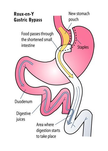 #HealthyHabits#FitLifeTips#SlimDownStrategies#NutritionNudge#WellnessJourney#MindfulEating#FitnessGoals#GetLean#ShapeUp#CalorieControl#ExerciseEveryday#HealthyEatingHabits#WeightLossJourney#BurnFat#StayActive#PortionControl#WorkoutMotivation#EatClean#FitInspiration#TransformationTuesday Gastric Surgery, Gastric Bypass Diet, Gastric Bypass Recipes, Bariatric Diet, Diets That Work, Bariatric Eating, Digestive Juice, Bypass Surgery, Bariatric Recipes