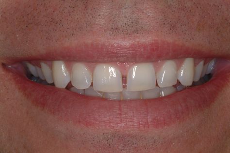 Short teeth and spacing Short Teeth, Dr Julie, Dental Images, Teeth Pictures, Grand Junction, After Photos, Dental Care