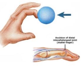 Did a ball or other object hit the end of your finger? Did you smack the end of your finger against something hard, or crush your fingertip in a door or drawer? If so, you may have Mallet Finger. Mallet Finger also called “baseball finger,” is when the end of your finger droops in a bent position and won’t straighten by itself. You can push your finger into a straight position but it won’t stay straight without support. What should you do about your mallet finger? Mallet Finger Splint, Mallet Finger, Nail Falling Off, Finger Injury, Broken Finger, Finger Splint, Broken Foot, Ligaments And Tendons, Leather Work Gloves