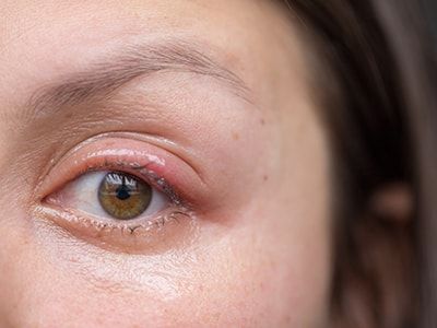 13 Natural Eye Stye Remedies - The Lost Herbs Natural Remedies For Stye Eye, Stye Remedies Fast How To Get Rid, Sty In Eye Remedies, Stye Remedies, Stye Remedy, Eye Stye Remedies, Natural Face Mask, Herbal Recipes, Natural Healing Remedies