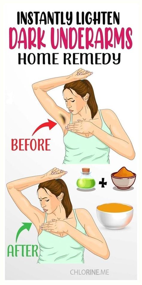 Unparalleled statistics. Whiten Underarms Fast, Acanthosis Nigricans, How To Whiten Underarms, Armpit Whitening, Natural Skin Moisturizer, Dark Armpits, Dark Underarms, Diy Remedies, Natural Cleanser