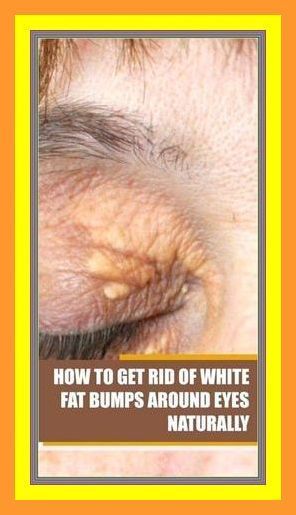 How To Get Rid of White Fat Bumps Around Eyes Naturally Millia Removal, White Bump On Eyelid, Essential Oils For Pregnancy, Lower Back Pain Exercises, Natural Hair Mask, Sciatic Nerve Pain, Skin Spots, Pregnant Diet, Skin Disorders