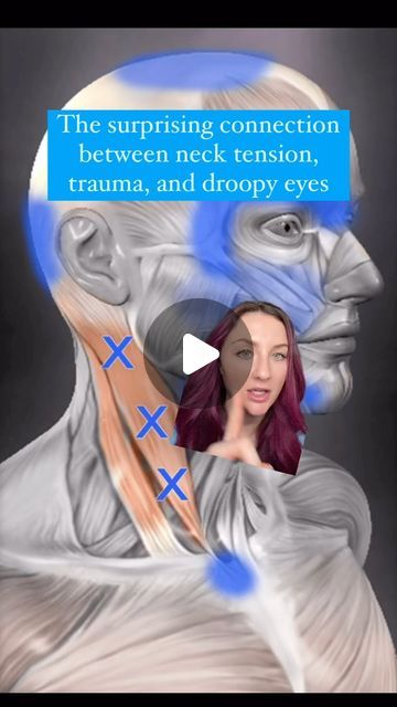 Sage | Facial Tension and Face Massage Expert on Instagram: "Neck tension and brow tension are intimately linked! 

Practioners who offer in-person trigger point massage often find that patients who come in with SCM tension also have ptosis and a drop of the brows/eyelids because of the connection between the SCM and brow/eye muscles. 

I’ve also noticed with my clients who have experienced their eyes become smaller and more “hooded” over time that adding extra focused work on the SCM (in addition to the Posture Stretches in the 30-Day Program that lengthen+release the SCM) gets them even more results for the eye area than just eye/brow massage alone. 

Facial Awareness is also key so that you tune in with what’s going on in the body and how it aligns with whatever you may be feeling in th Posture Stretches, Eye Muscles, Neck Tension, Trigger Point Massage, Droopy Eyes, Trigger Point, Eye Brow, Trigger Points, Face Yoga