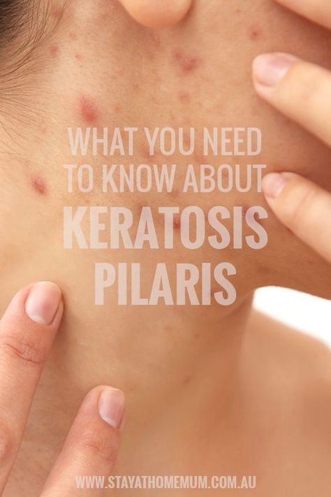 Keratosis pilaris is a common, but harmless, skin condition that is often misdiagnosed as acne or other skin issues. When we say common, we really mean common. Itchy Bumps On Skin, Pimple Under The Skin, Cystic Acne On Chin, Blind Pimple, Stubborn Acne, Pimples Under The Skin, Home Remedies For Skin, Pimples Remedies, Skin Bumps